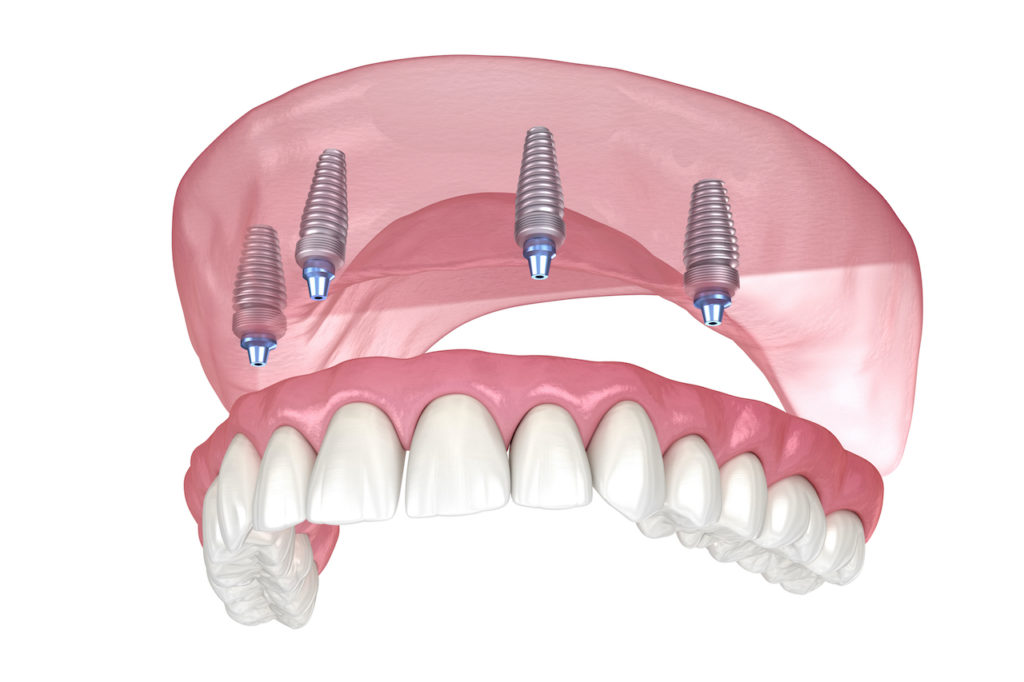 hybrid dentures