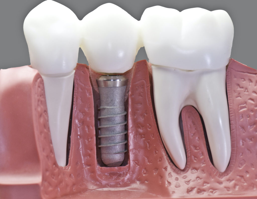 Dental implants in Largo, FL