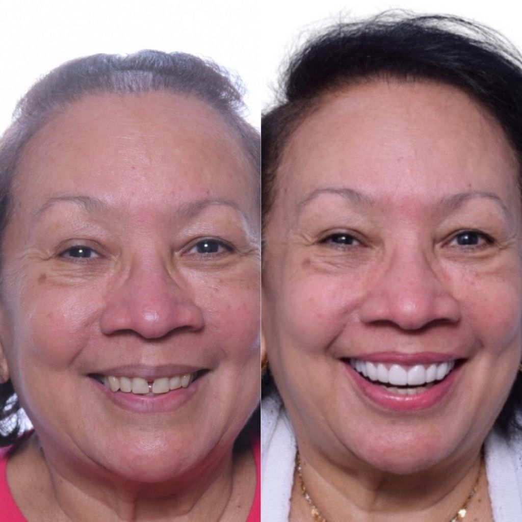 Veneer Dental