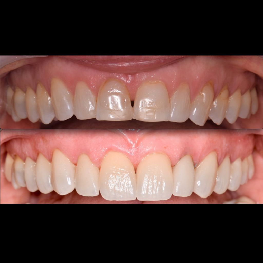 veneer dental befrore and after teeth