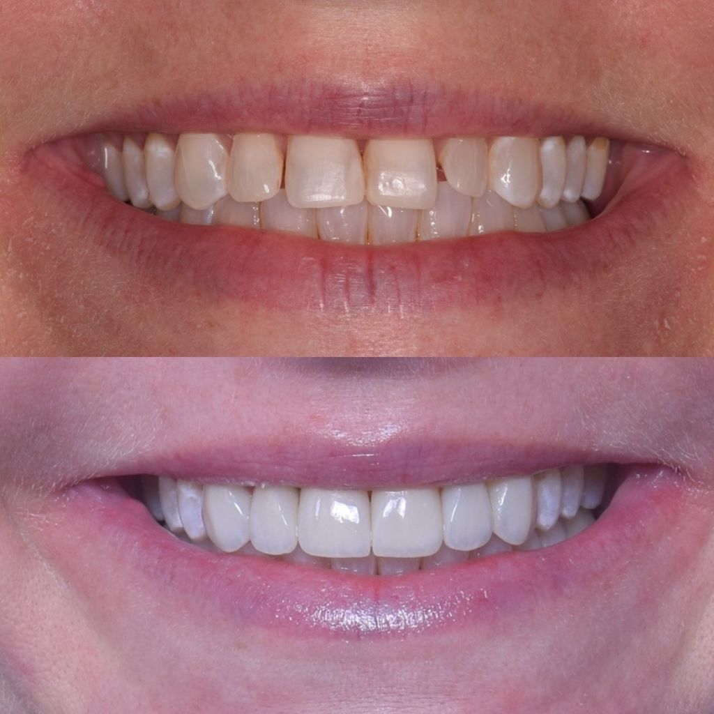 veneer dental center