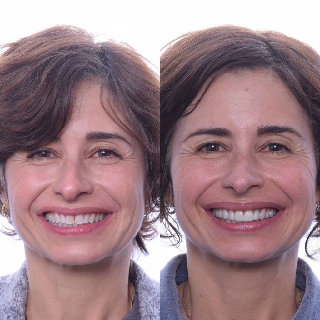 veneer dental clinic florida