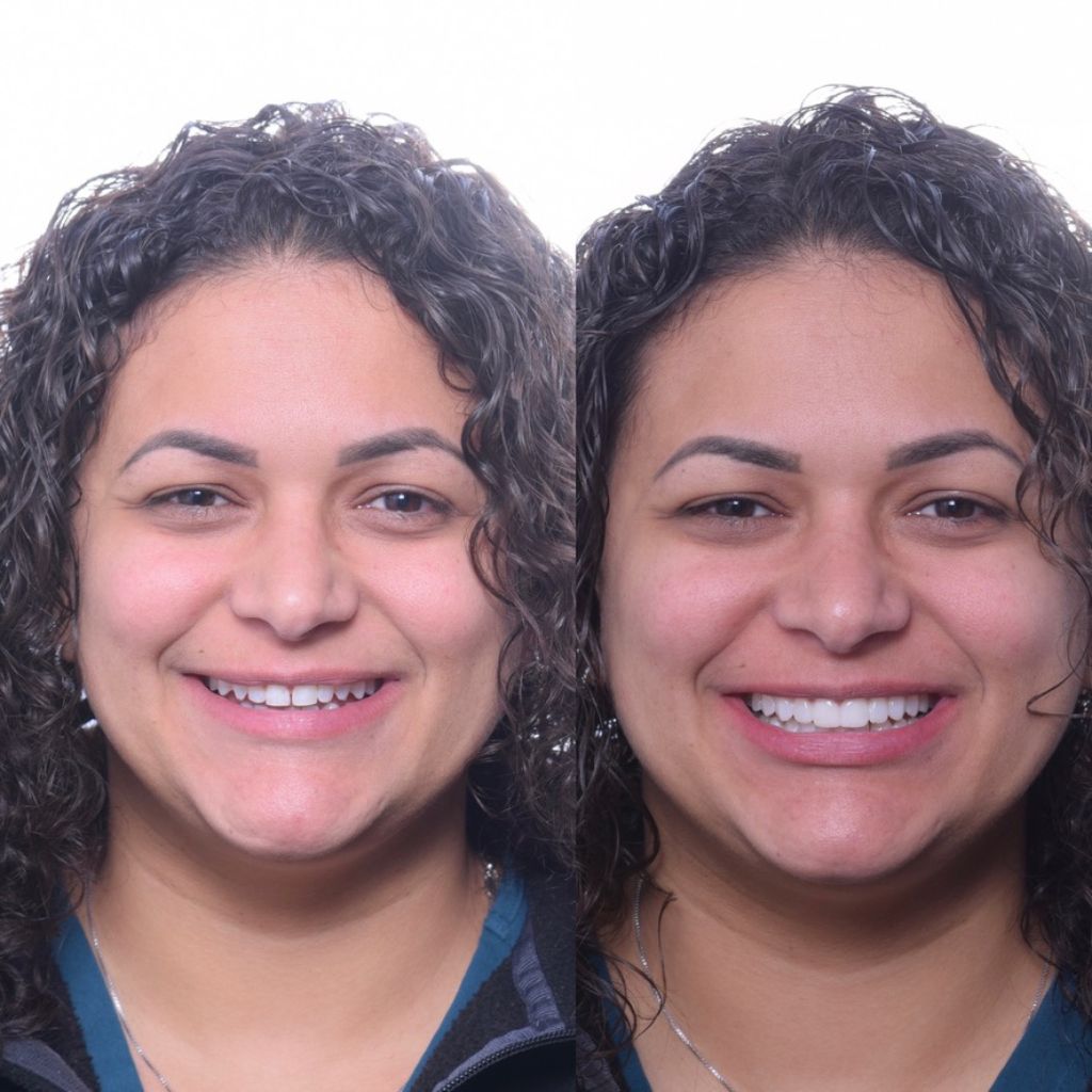 veneer dental clinic