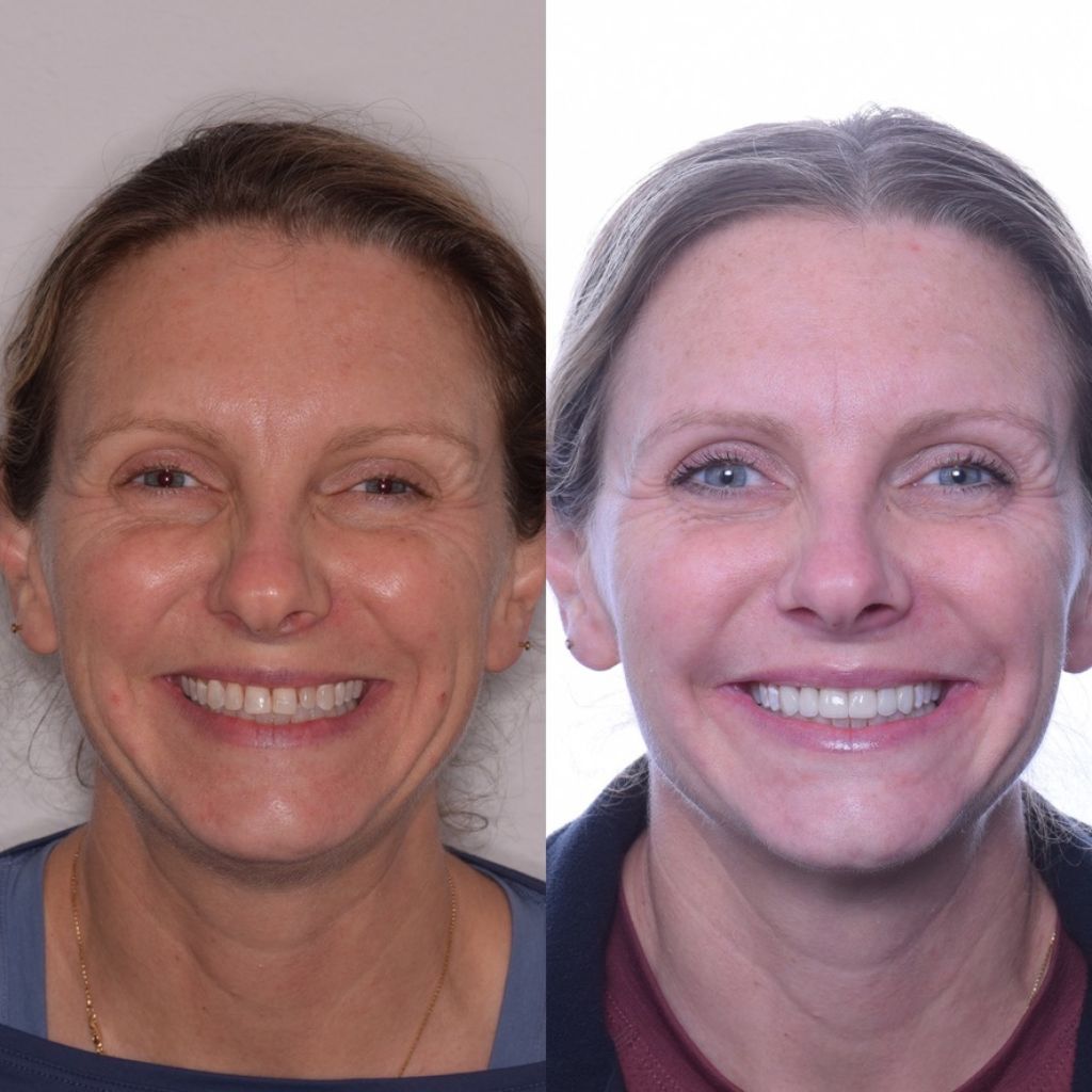veneer dental treatment